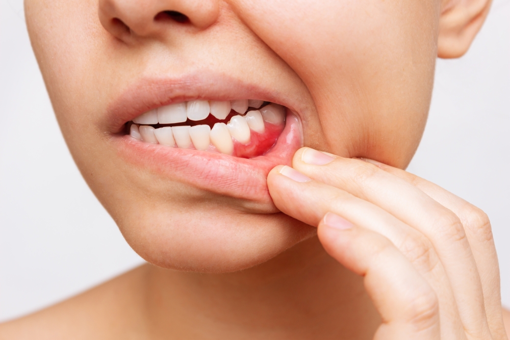 Bleeding Gums and Diabetes